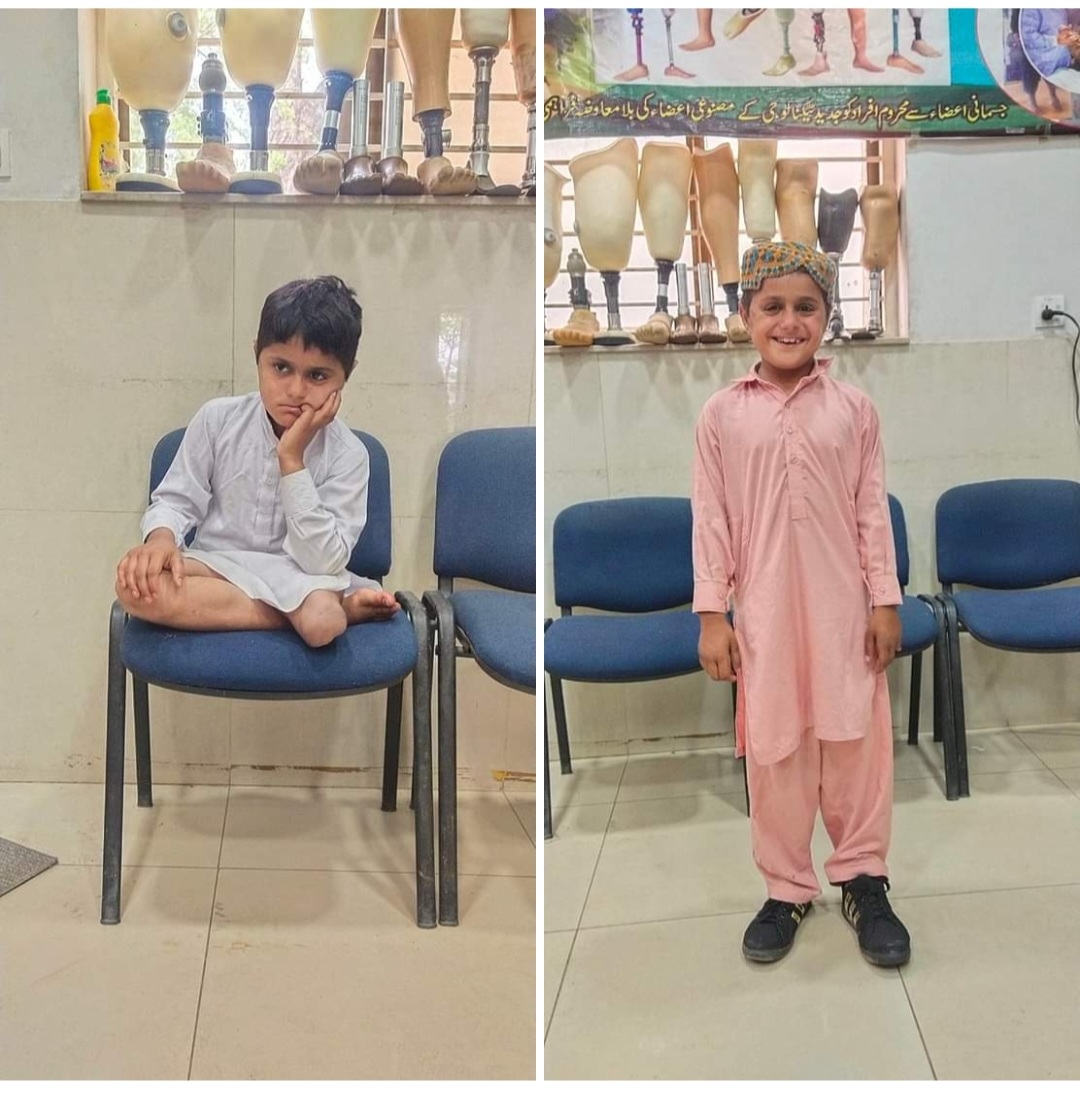 Knee Disarticulation Prosthesis