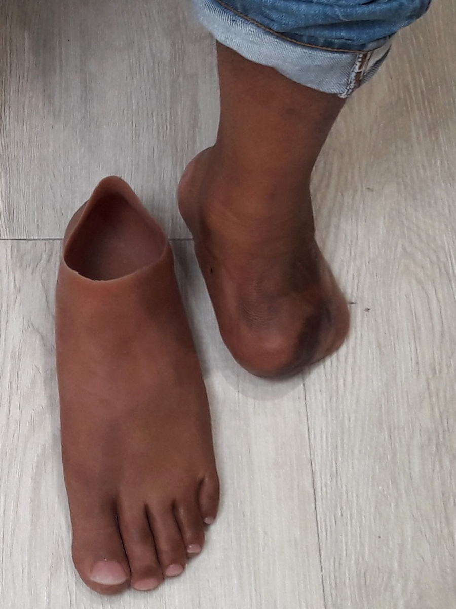 Partial Foot Prosthesis